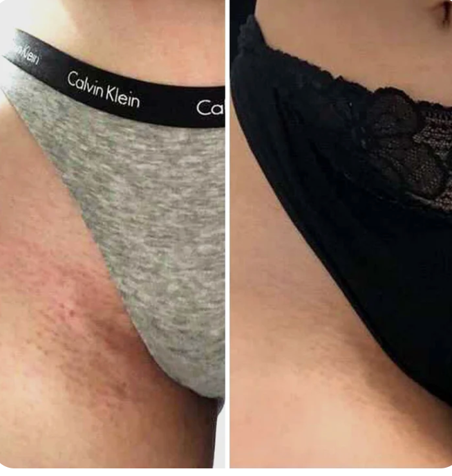 FriendBikini™  Rasage doux sans irritation