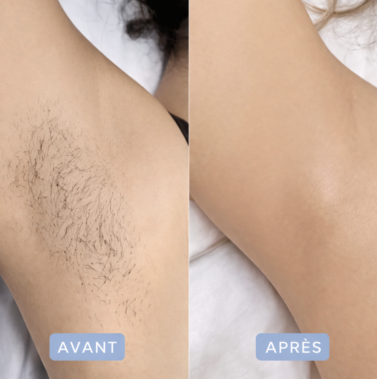 "Friend Bikini" L'épilation qui n'assèche pas votre peau.