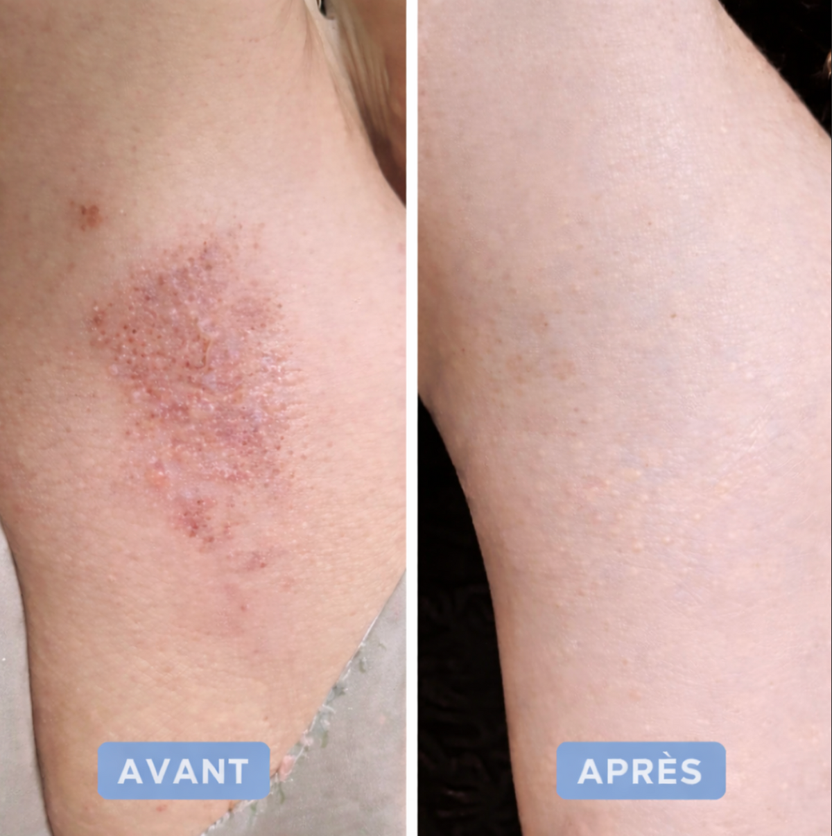 "Friend Bikini" L'épilation qui n'assèche pas votre peau.